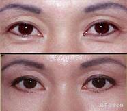 怎么样消除眼袋与眼袋