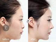 经常玻尿酸隆鼻好不好(玻尿酸隆鼻的作用与危害原理)