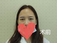 长沙女子隆鼻注射玻尿酸后视力骤降 女子当场昏迷视力骤降 长沙女子隆鼻注射玻尿酸后视力骤降 女子当场昏迷视力骤降