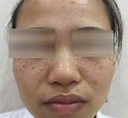 激光祛斑效果怎么样与激光祛斑