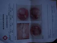 得了痔疮会怎么样与痔疮