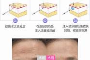 抬头纹怎么去除