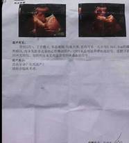 药流怎么样与药流