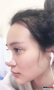 隆鼻怎么样与隆鼻