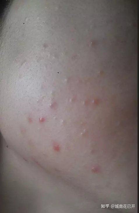 达人分享！去粉刺护肤品“星星点点”