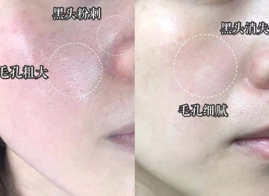 达人分享！果酸换肤霜“冰清水冷”