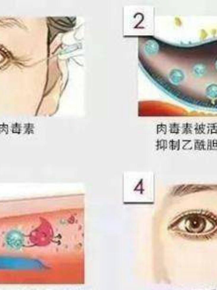 讲解！咬肌发达怎么办“典则俊雅”