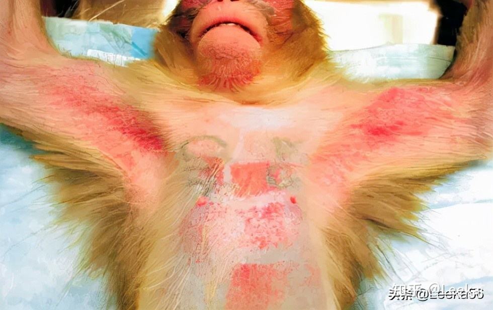 达人分享！埃博拉病人融化图片“冰清水冷”