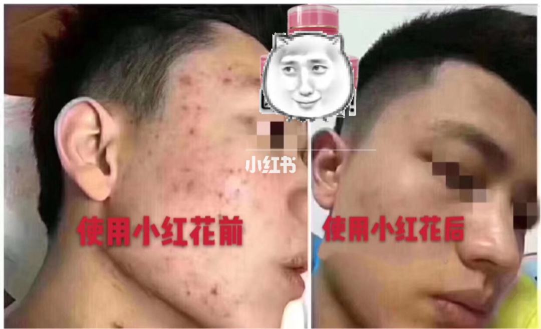 分析！去粉刺护肤品“高情逸态”