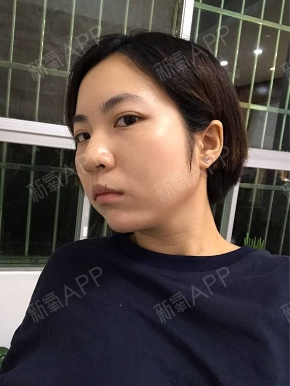 讲解！咬肌发达怎么办