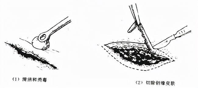 分析！医用蛆虫“星星点点”