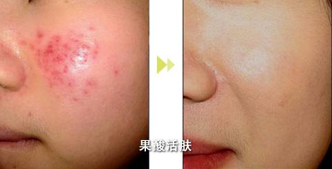 分析！果酸换肤霜