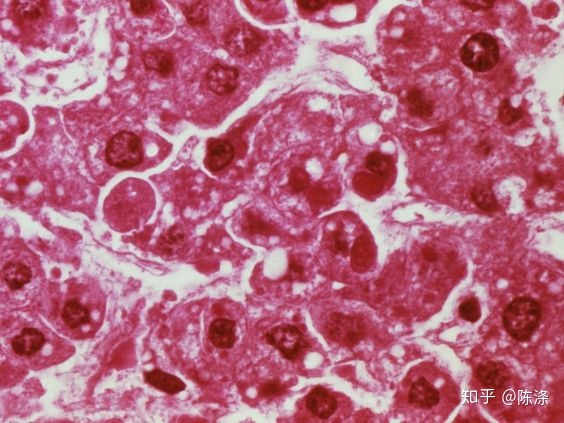 讲解！埃博拉吐内脏图“桃红柳绿”