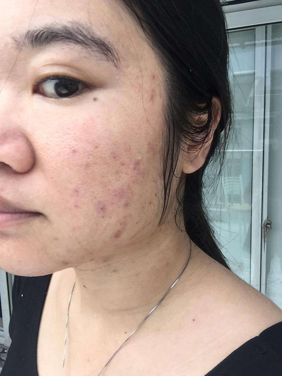 讲解！果酸换肤霜“冰清水冷”