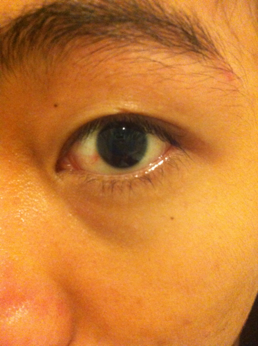 讲解！眼睛充血怎么快速消除“冰清水冷”