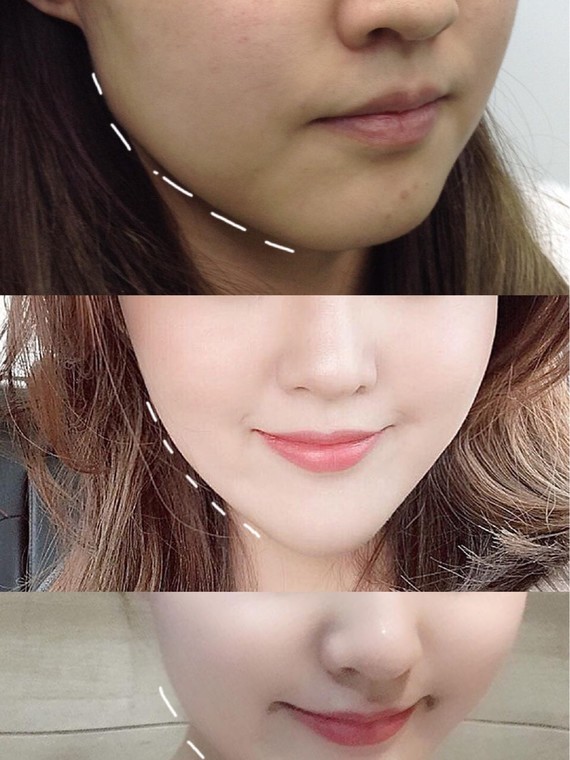 达人分享！咬肌发达怎么办